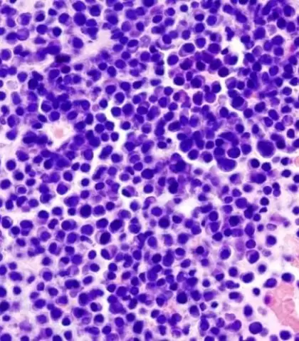 Multiple_myeloma_2_HE_stain