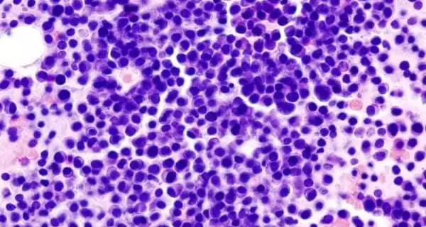 Multiple_myeloma_2_HE_stain